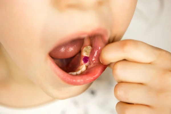 少女のミルクの歯を噛む上で色の紫色の充填 小児科 治療と検査 開いた口を持つ子供は白い背景に閉じて歯を示しています — ストック写真