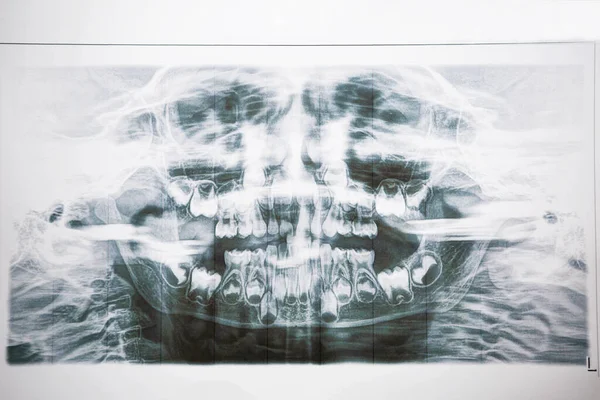 Radiografia Dentária Leite Dos Molares Bebé Duas Fileiras Dentes Mudar — Fotografia de Stock