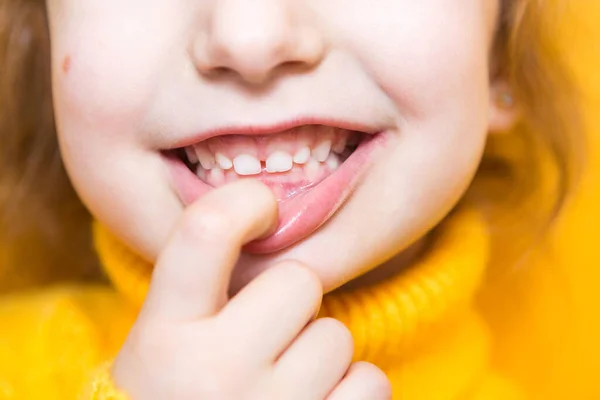 Dívka Ukazuje Své Zuby Patologické Kousnutí Malokluze Předkus Dětská Stomatologie — Stock fotografie
