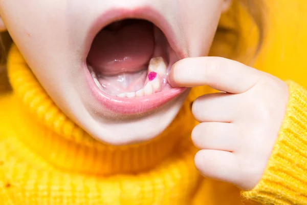 Farbige Violette Füllung Auf Dem Milchkauzahn Des Mädchens Kinderzahnheilkunde Behandlung — Stockfoto