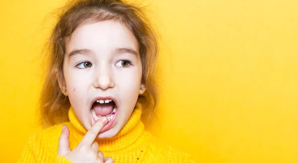 Kızın süt çiğneyen dişinde renkli mor dolgu var. Pediatrik dişçilik, tedavi ve muayene. Ağzı açık bir çocuk sarı arka planda yakın plan bir dişi gösterir..