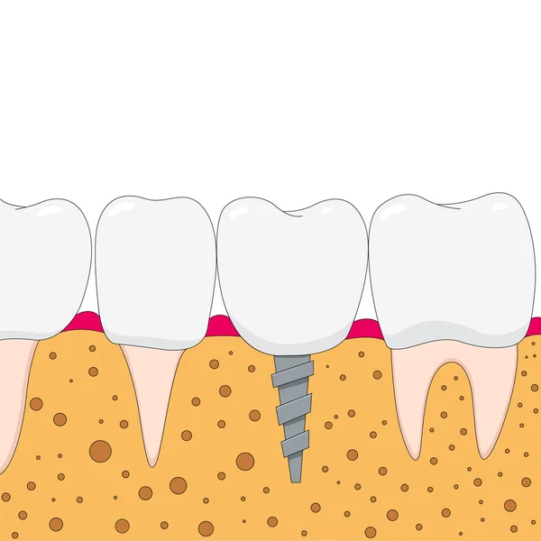 Implante dental — Vector de stock