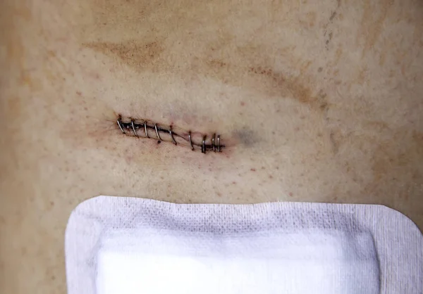 Detail of medical operation, stitches for healing, post-operative