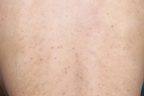 Problema Saúde Doenças Pele Homem Mostrando Costas Com Acne Manchas — Fotografia de Stock