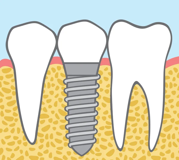 One Dental implant — Stock Vector