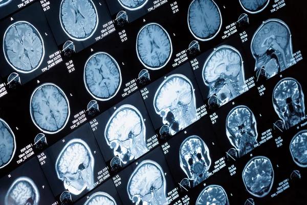 mri con contraste de la cabeza mri con contraste de la cabeza