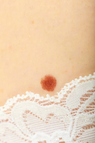 Closeup brown mole on caucasian woman skin. — Stock Photo, Image