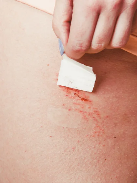 Human sticking plaster adhesive bandage to wound. — Stock Photo, Image