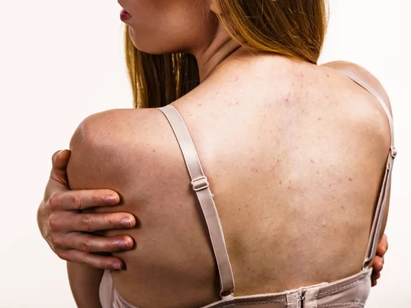 Health Problem Skin Diseases Young Woman Showing Her Back Acne — Stock Photo, Image