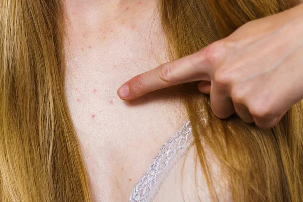 Gezondheidsproblemen Huidziekten Jonge Vrouw Toont Haar Hals Met Acne Rode — Stockfoto