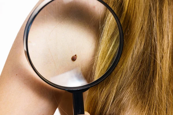Skin Disease Closeup Brown Mole Human Body Female Checking Moles — Stock Photo, Image