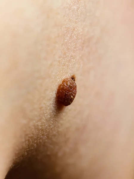 Skin Disease Closeup Brown Mole Caucasian Human Body — Stock Photo, Image