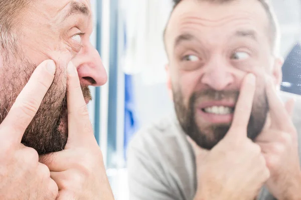 大人の男が顔に彼のにきびを調査する 男はそれを絞るにきびを取り除くしようとしている — ストック写真