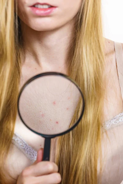 健康问题 皮肤病 年轻女人脖子上有粉刺红斑有粉刺的女性 — 图库照片