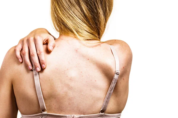Health Problem Skin Diseases Young Woman Showing Her Back Acne — Stock Photo, Image