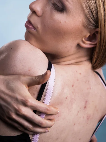 Problema Salud Enfermedades Piel Mujer Joven Mostrando Espalda Con Acné — Foto de Stock