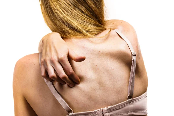 Health Problem Skin Diseases Young Woman Showing Her Back Acne — Stock Photo, Image