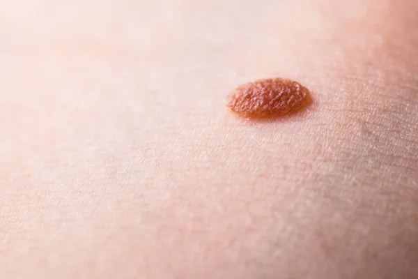 Skin Disease Closeup Brown Mole Caucasian Human Body — Stock Photo, Image