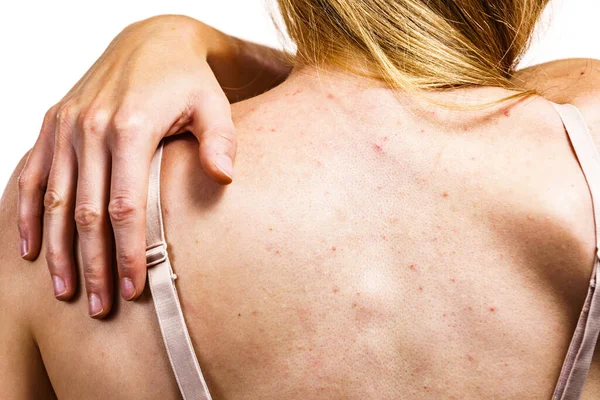 Health Problem Skin Diseases Young Woman Showing Her Back Acne — Stock Photo, Image