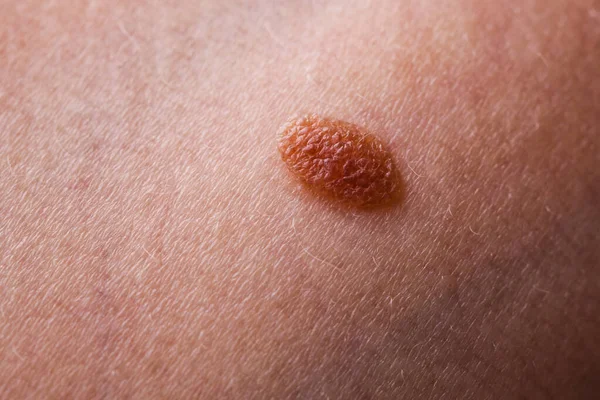 Skin Disease Closeup Brown Mole Caucasian Human Body — Stock Photo, Image