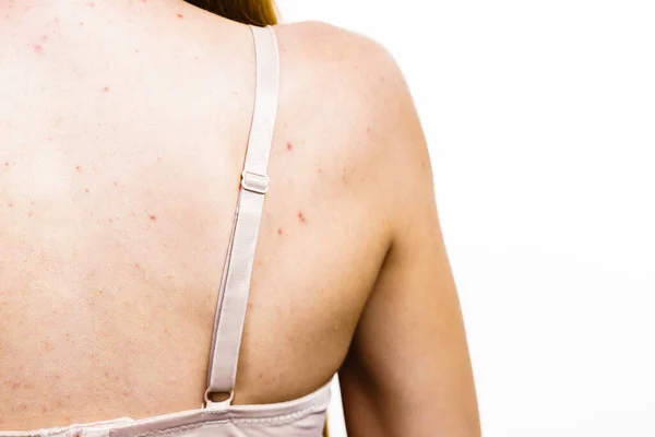 Health Problem Skin Diseases Young Woman Showing Her Back Acne — Stock Photo, Image