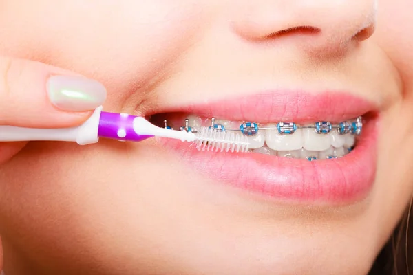 Dentist Orthodontist Concept Young Woman Cleaning Brushing Teeth Blue Braces — Stock Photo, Image