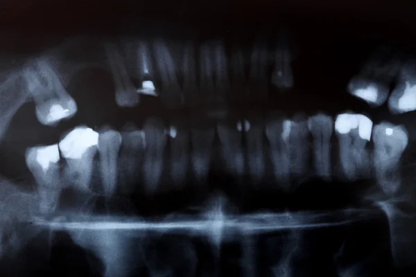 X-ray scan of humans teeth — Stock Photo, Image