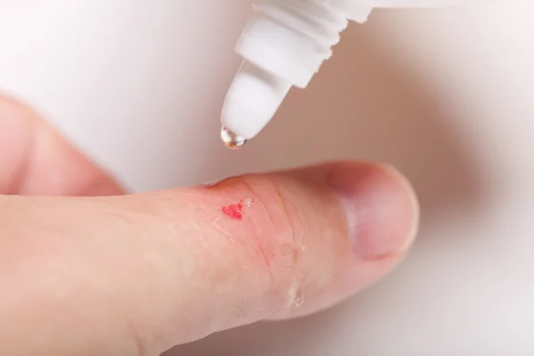 Desinfecte el rasguño en la mano —  Fotos de Stock