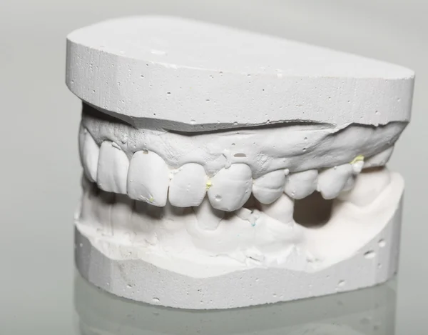 Mould of teeth in plaster — Stockfoto