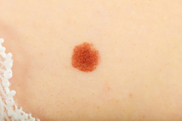 Closeup brown mole on caucasian woman skin. — Stock Photo, Image