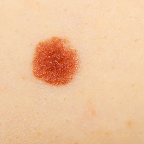 Closeup brown mole on caucasian woman skin. — Stock Photo, Image