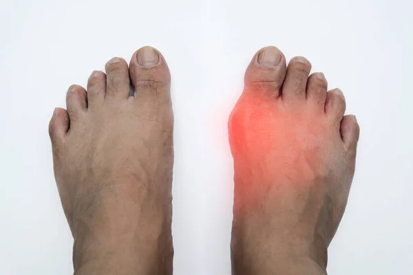 Pair Feet Deformed Right Toe Due Painful Gout Inflammation Painful — Stock Photo, Image