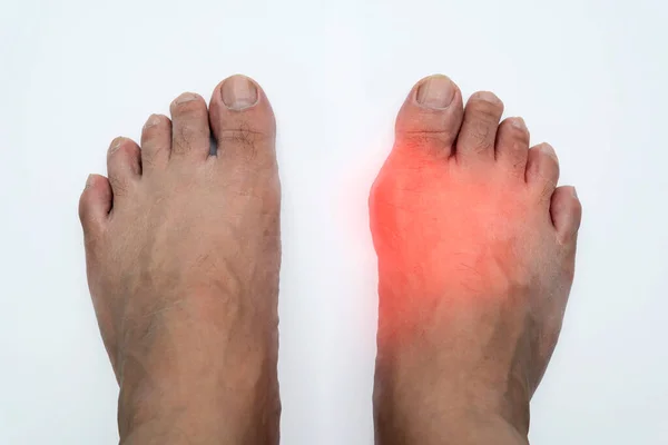 Pair Feet Deformed Right Toe Due Painful Gout Inflammation Painful — Stock Photo, Image