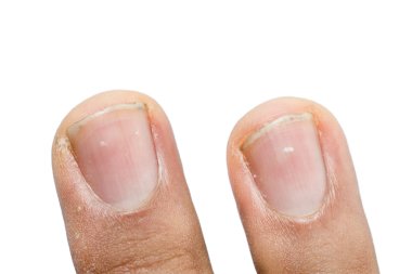 White spots on fingernails clipart