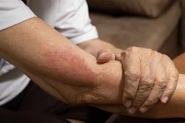 Vaccino Covid Allergie Sintomo Negli Anziani Dopo Vaccinazione — Foto Stock
