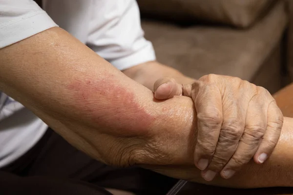 Vaccin Covid Allergier Symptom Hos Äldre Efter Vaccination — Stockfoto