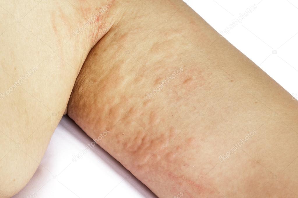 Allergic rash skin of patient arm