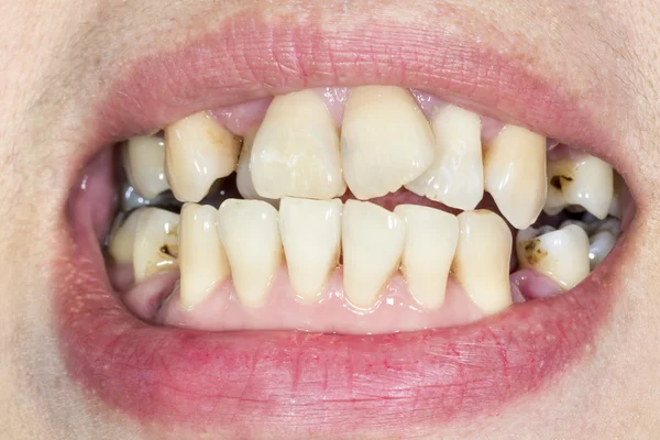 Dientes torcidos antes de aparatos ortopédicos — Foto de Stock