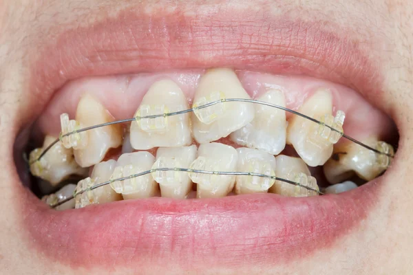 Bliska jamy ustnej krzywe zęby z nawiasy klamrowe. — Zdjęcie stockowe