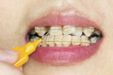 Çarpık dişler diş telleri, fırçalama interdental ile