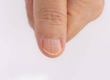 Çivilerdeki dikey çıkıntılar, onikoreheksi olarak da bilinir..