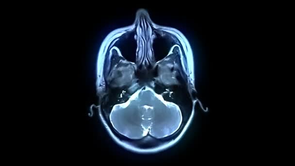 MRI Escaneamento cerebral — Vídeo de Stock