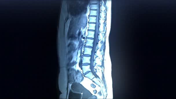 Analyse IRM de la colonne vertébrale 