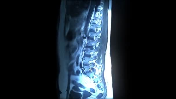 Analyse IRM de la colonne vertébrale 