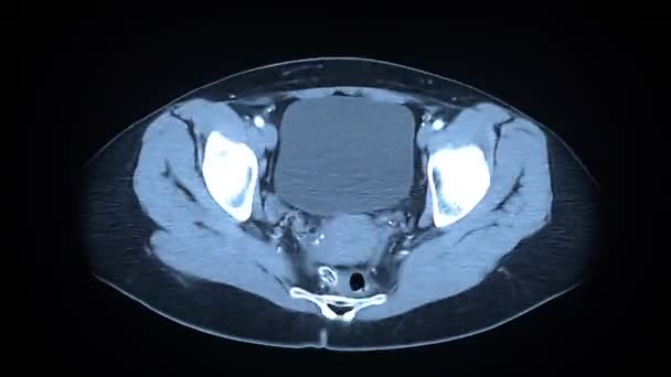 Omurga MRI tarama — Stok video