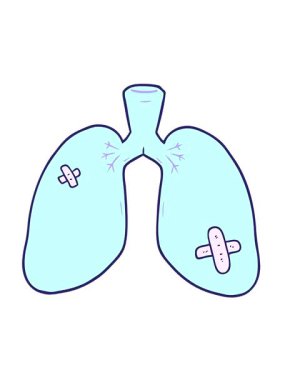 Karikatürlerdeki titreşimli hareketler onarılmış akciğerler.