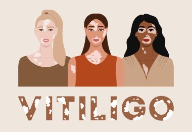Set of female faces with vitiligo. World Vitiligo Day poster. Collection of portraits of women with different skin color and hairstyles. Body positive concept. Hand drawn vector illustration. clipart