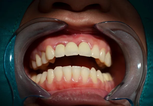 Tutti i ponti in ceramica dei denti superiori anteriori — Foto Stock