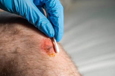 Doktor dizindeki sıyrığı pamuklu çubukla temizliyor.