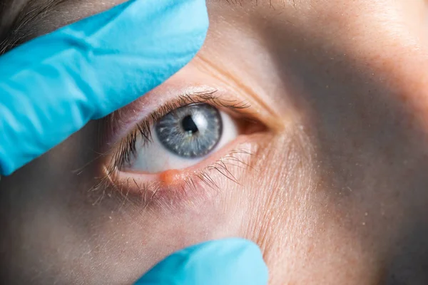 Doctor examines the blue eye of the patient